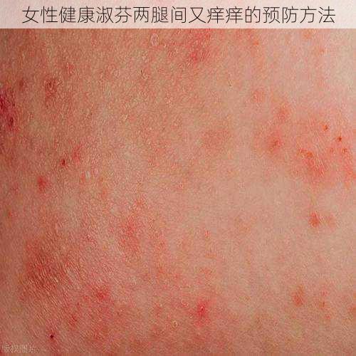 女性健康淑芬两腿间又痒痒的预防方法